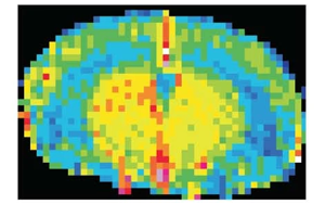 Nature Neuroscience:一種免疫蛋白可能誘發與高血壓無關的癡呆 Nature Neuroscience:一種免疫蛋白可能誘發與高血壓無關的癡呆