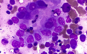 《Science》發現乳腺癌與大腦的“高速通路”——神經元